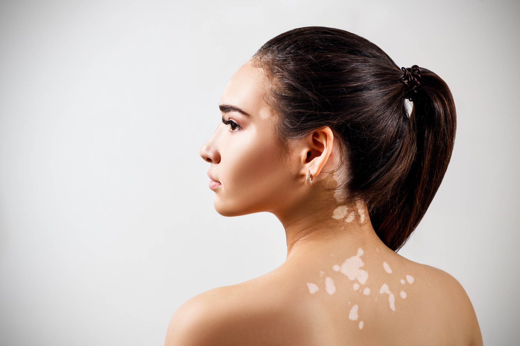 Portrait of young woman with vitiligo