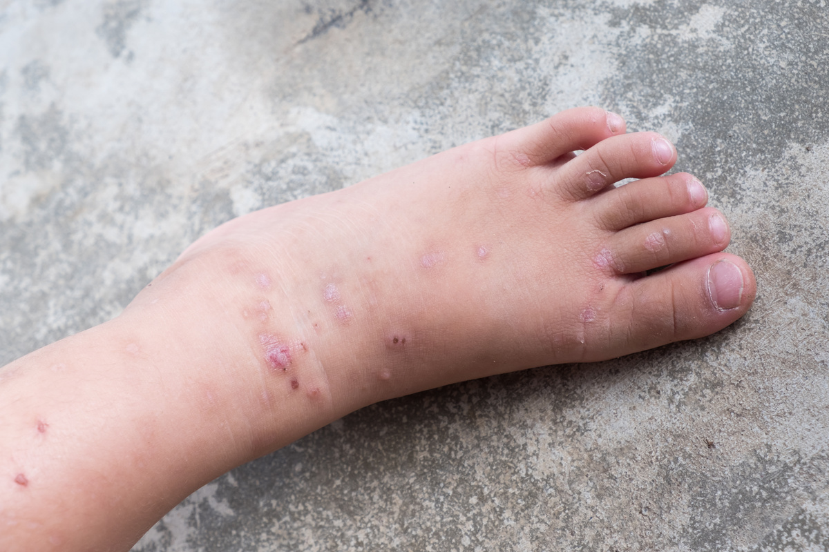 Itchy dermatitis atopic baby foot.